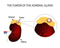 Adrenal Cancer Treatment