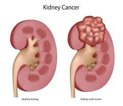 Kidney Stones Treatment