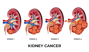 Kidney Cancer Treatment