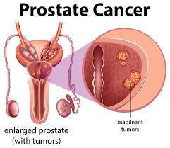 Prostate Cancer Treatment