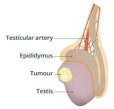 Testicular Cancer Treatment
